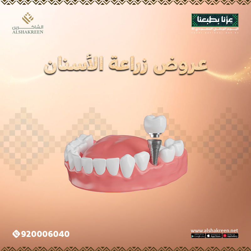 عروض زراعة الأسنان