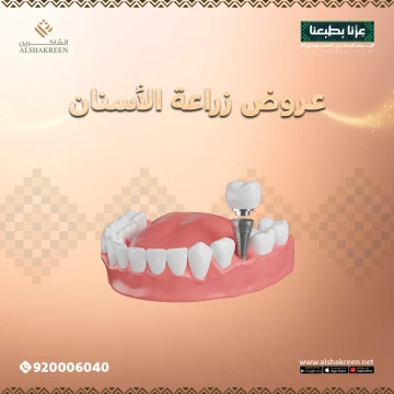 عروض زراعة الأسنان