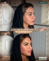 <p>تجميل كامل الوجه&nbsp;</p>