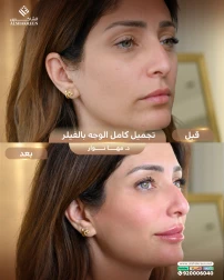 <p>تجميل كامل الوجه&nbsp;</p>