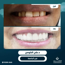 <p><a href="https://alshakreen.net/public/ar/offers/Dental-offers?page=2">إبتسامة هوليوود</a><br />
&nbsp;</p>