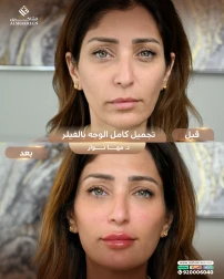 <p>تجميل كامل الوجه&nbsp;</p>