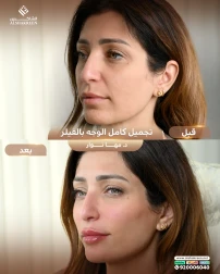 <p>تجميل كامل الوجه&nbsp;</p>